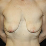 Breast Lift with Implant Before & After Patient #26984