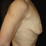 Breast Lift with Implant Before & After Patient #26984