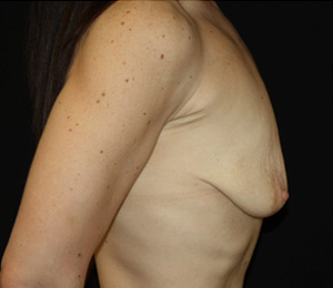 Breast Lift with Implant Before & After Patient #26984