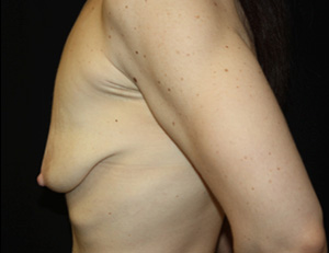 Breast Lift with Implant Before & After Patient #26984
