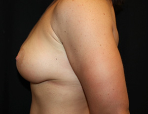 Breast Lift with Implant Before & After Patient #26984