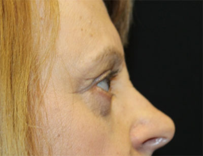 Blepharoplasty and Brow Lift Before & After Patient #25361