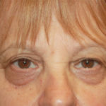 Blepharoplasty and Brow Lift Before & After Patient #25361