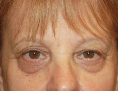 Blepharoplasty and Brow Lift Before & After Patient #25361