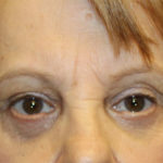 Blepharoplasty and Brow Lift Before & After Patient #25361