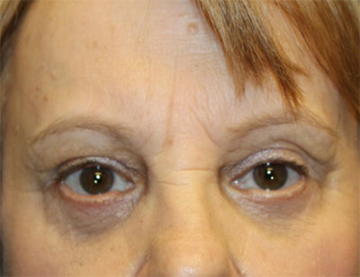 Blepharoplasty and Brow Lift Before & After Patient #25361