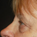 Blepharoplasty and Brow Lift Before & After Patient #25361