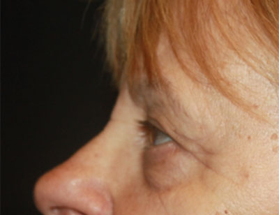 Blepharoplasty and Brow Lift Before & After Patient #25361