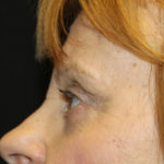 Blepharoplasty and Brow Lift Before & After Patient #25361