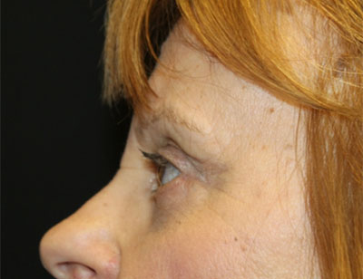 Blepharoplasty and Brow Lift Before & After Patient #25361