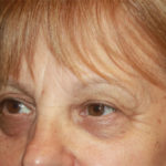 Blepharoplasty and Brow Lift Before & After Patient #25361