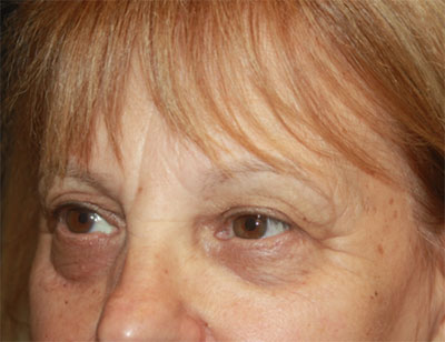 Blepharoplasty and Brow Lift Before & After Patient #25361