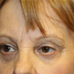 Blepharoplasty and Brow Lift Before & After Patient #25361