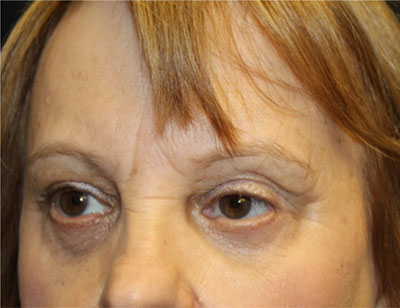 Blepharoplasty and Brow Lift Before & After Patient #25361