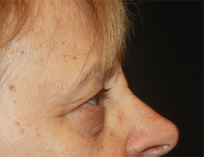 Blepharoplasty and Brow Lift Before & After Patient #25361