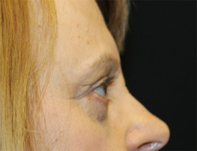 Blepharoplasty and Brow Lift Before & After Patient #25361