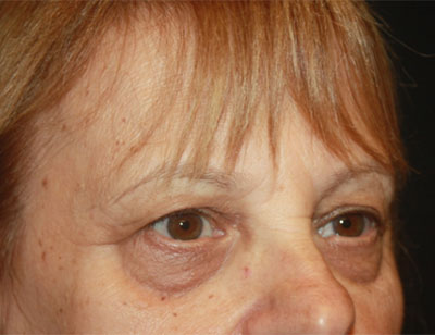 Blepharoplasty and Brow Lift Before & After Patient #25361