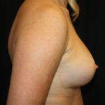 Breast Augmentation - Shaped Silicone Implants Before & After Patient #26505