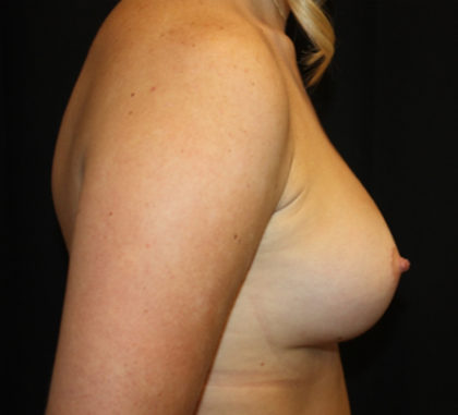 Breast Augmentation - Shaped Silicone Implants Before & After Patient #26505