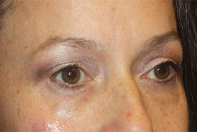 Blepharoplasty and Brow Lift Before & After Patient #25381