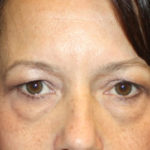 Blepharoplasty and Brow Lift Before & After Patient #25381