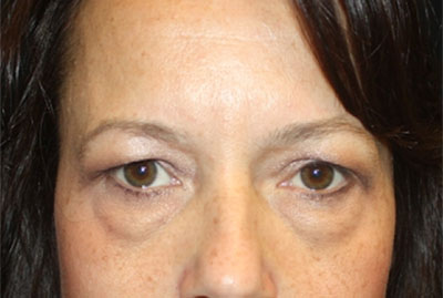 Blepharoplasty and Brow Lift Before & After Patient #25381