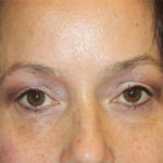 Blepharoplasty and Brow Lift Before & After Patient #25381