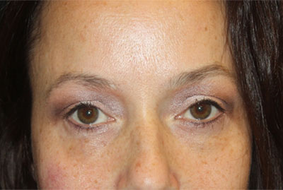 Blepharoplasty and Brow Lift Before & After Patient #25381