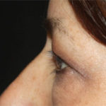 Blepharoplasty and Brow Lift Before & After Patient #25381