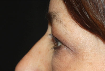 Blepharoplasty and Brow Lift Before & After Patient #25381