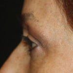 Blepharoplasty and Brow Lift Before & After Patient #25381