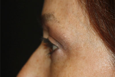 Blepharoplasty and Brow Lift Before & After Patient #25381