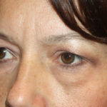 Blepharoplasty and Brow Lift Before & After Patient #25381