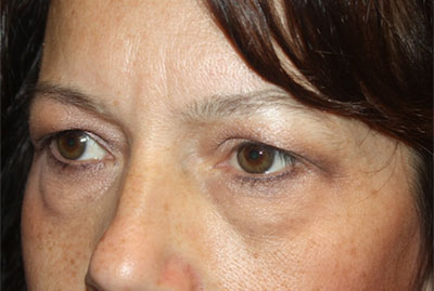 Blepharoplasty and Brow Lift Before & After Patient #25381