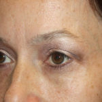 Blepharoplasty and Brow Lift Before & After Patient #25381