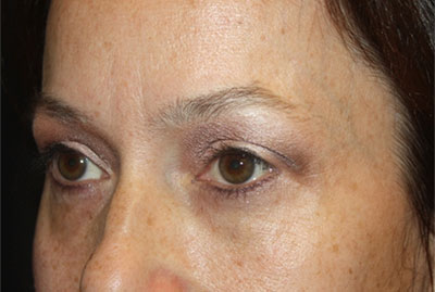 Blepharoplasty and Brow Lift Before & After Patient #25381