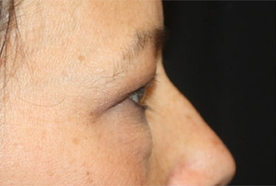 Blepharoplasty and Brow Lift Before & After Patient #25381