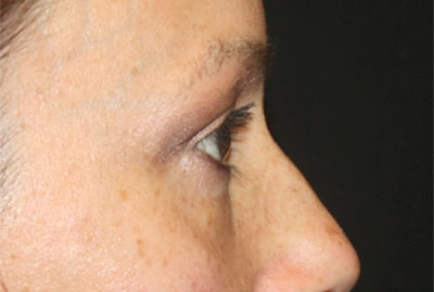 Blepharoplasty and Brow Lift Before & After Patient #25381