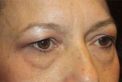 Blepharoplasty and Brow Lift Before & After Patient #25381