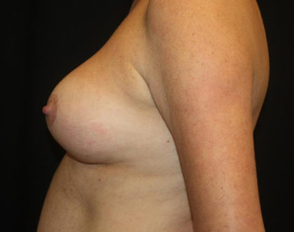 Breast Lift with Implant Before & After Patient #26742