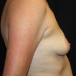 Breast Lift with Implant Before & After Patient #26742