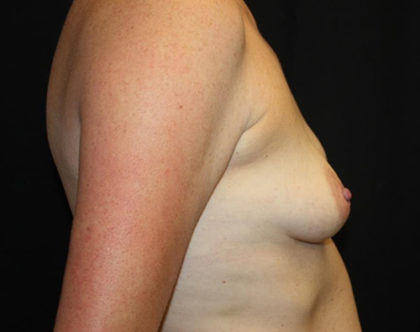 Breast Lift with Implant Before & After Patient #26742