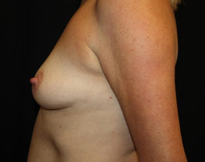 Breast Lift with Implant Before & After Patient #26742