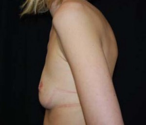 Breast Augmentation - Round Silicone Implants Before & After Patient #26328