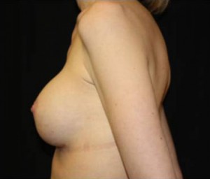 Breast Augmentation - Round Silicone Implants Before & After Patient #26328