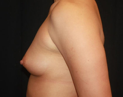 Breast Augmentation - Round Silicone Implants Before & After Patient #25564