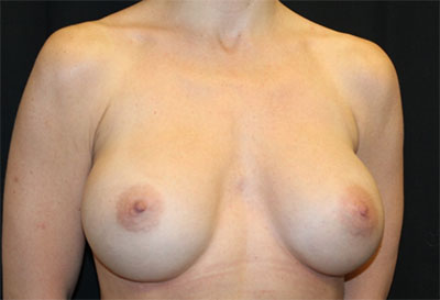 Breast Augmentation - Round Silicone Implants Before & After Patient #25484