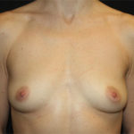 Breast Augmentation - Round Silicone Implants Before & After Patient #25484