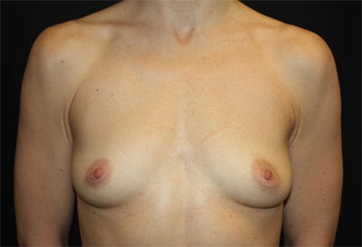 Breast Augmentation - Round Silicone Implants Before & After Patient #25484