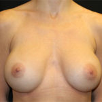 Breast Augmentation - Round Silicone Implants Before & After Patient #25484